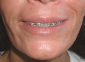 Felső fogíny kivillanás botox kezelése